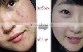 Product name 100% pure organic tea tree oil for acne treatment with private label indications s ore muscles, relaxation, therapeutic massage, relaxing massage, sports. Best Tea Tree Oil Ance Treatment Cream For Remove Acne Scars Of Acne From China Suppliers 137946063