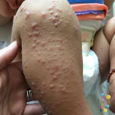 Image result for Papular Acrodermatitis
