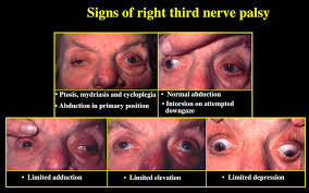 Image result for Pupillary Paralysis