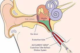 Eustachian Tube Dysfunction | Carecredit | North Dallas Ent