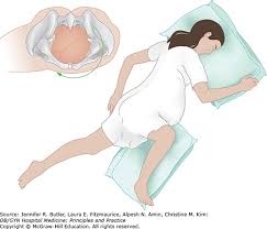 Image result for Manual Rotation in Occipitoposterior Presentation