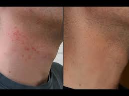 How To Cure Razor Burn Bumps On Neck & Legs! - Youtube
