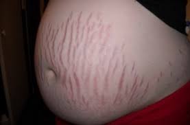 Resultado de imagen de cambios dermatologicos en el embarazo