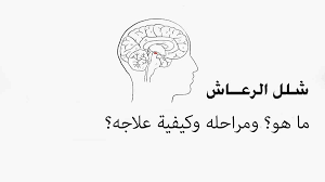Check spelling or type a new query. ØªØ´Ø®ÙŠØµ ÙˆØ¹Ù„Ø§Ø¬ Ø´Ù„Ù„ Ø§Ù„Ø±Ø¹Ø§Ø´ ÙˆÙ‚Ø§ÙŠØªÙŠ