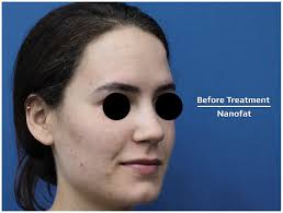 Nanofat in Facial Rejuvenation