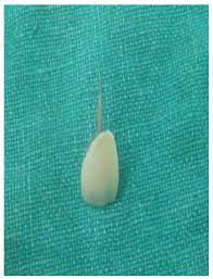 Choose from 16 dental crowns clinics in richmond, london with 26 verified patient reviews ★ find the best one for you. Successful Rehabilitation Of Anterior Crowns With Richmond Crown Case Series