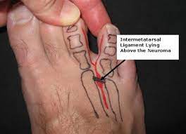 This is an intraoperative clip during excision and removal of painful neuroma between second and third toes. Interdigital Morton S Neuroma Foot Ankle Orthobullets
