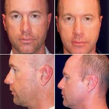 Revision Rhinoplasty