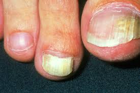 Image result for onychomycosis