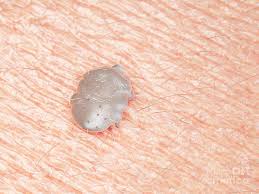 Image result for human scabies
