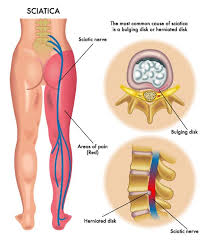 Think You Have Sciatica Heres What You Need To Know
