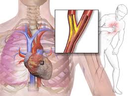 Image result for Angina Pectoris
