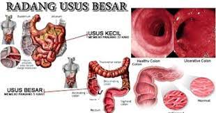 Cara Menyembuhkan Radang Usus Besar Penyakit Bagian Tubuh Paru Paru
