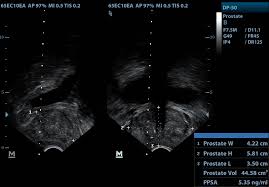 Prostate cancer basics gives an overview of this common type of cancer. Transrectal Ultrasound And Prostate Biopsy Trus Biopsy Urology Associates