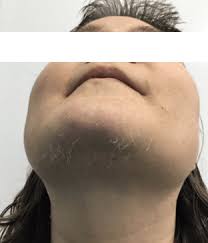 Apart from body weight and skin issues, pcos hair loss can be daunting to deal. Laser Hair Removal For Polycystic Ovary Syndrome The Cosmetic Clinic