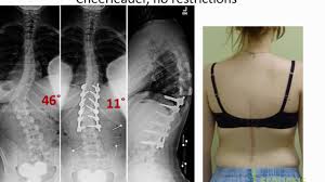 We did not find results for: What To Expect Returning To Full Function After Scoliosis Surgery Youtube