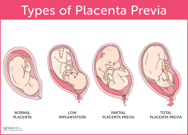 Mga resulta ng larawan para sa Placenta Previa"