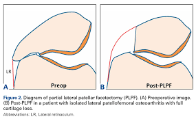 Image result for Patellar Tilt Test