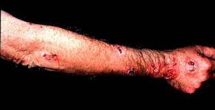 Caused by the fungus sporothrix schenckii found on rose thorns. Sporothrix Schenckii Cause Of Rose Picker S Disease Tom Volk S Fungus Of The Month For February 2003