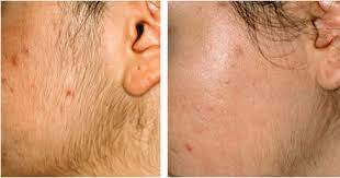 For best results, treat hairs every 1 to 2 weeks for 2 months. Permanent Facial Hair Removal Laser Hair Removal Guide