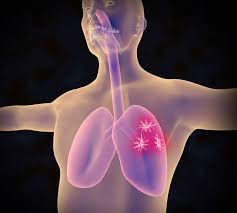 How breast cancer spreads to the lungs breast cancer starts in the breast. When Cancer Spreads To The Lungs What To Know Premier Health