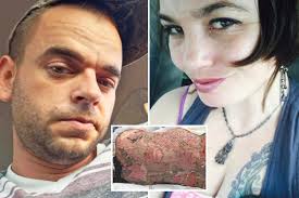 I was scarred for life and suffered 80% burns after evil boyfriend set me 