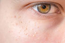 Apply the warm compress 10 to 15 minutes three to four times a day. Milia Causes How To Get Rid Of It Prevention
