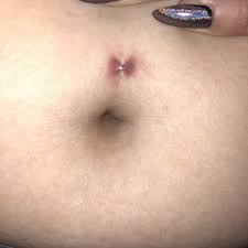 What Is Wrong With My Belly Button Piercing The Skin That The Bar Is Through Is Very Red And Sore Photos
