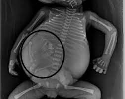 Fetus in fetu (FIF), a rare congenital anomaly – Shasthra Snehi