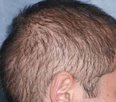 A tingling scalp is a fairly common condition, and one that can mean a variety of things. Case 4 Diffusely Thin Hair