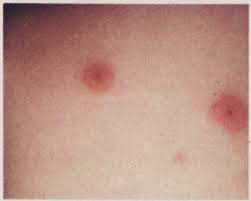 Image result for Rickettsialpox