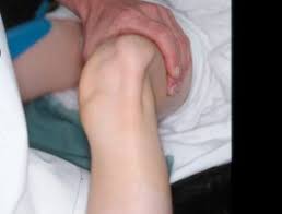 Image result for Patellar Dislocation