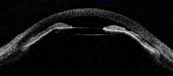 Malignant Glaucoma | IntechOpen