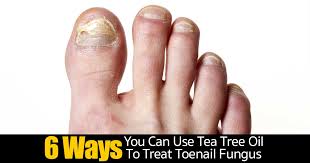 tea tree oil to treat toenail fungus