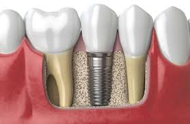 This coverage is underwritten by. Best Dental Implants Snellville Family Dental Snellville Ga