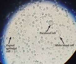 Image result for Vaginitis