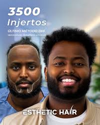 Turkish Hair Transplant in Cancun/Mexico