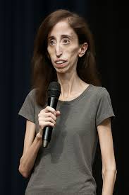 Lizzie Velasquez rare medical condition