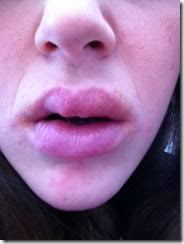 Mango allergy: The fruit that destroyed my face (pics)