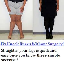 Best Exercises On How To Fix Knock Knees Improving My Appearance Knock Knees Knock Knees Correction Knock Knees Exercises