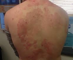 Image result for Atopic Dermatitis