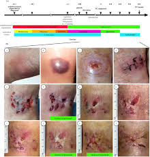 Image result for Pyoderma Gangrenosum