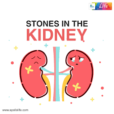 Kidney Stones Are Formed When An Imbalance Occurs In Various Chemicals That Are Present In The Urine Learn To Take Pr Kidney Calcium Stones Wellbeing Magazine