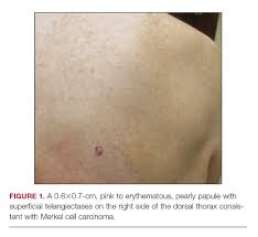 Merkel cell carcinoma is a rare type of skin cancer that usually starts in areas of skin exposed to the sun. Merkel Cell Carcinoma In A Patient With A History Of Psoriasis Mdedge Dermatology