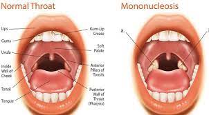 Mono is an infection caused by a virus. Plk Lancet Kenya On Twitter It S Very Rare For The Disease To Be Spread Through Blood Or Other Bodily Fluids The Ebv Test Is Also Known As Ebv Antibodies It S A Blood