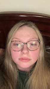 Butterfly rash, bruising