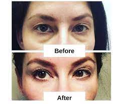 How to fix hollow eyes. 15 Home Remedies For Sunken Eyes