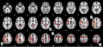 Probabilistic approach to consciousness and. How Ai And Machine Learning Are Aiding Schizophrenia Research Think Blog