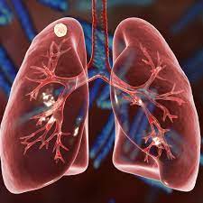 It most commonly affects the lungs. Fighting Tuberculosis Databases Are New And Powerful Weapons