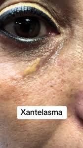 Image result for xantelasma
